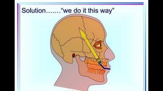 HIGH PULL HEADGEAR.pptx