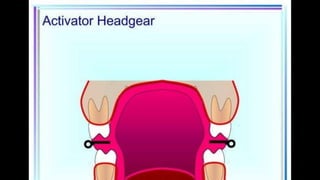 HIGH PULL HEADGEAR.pptx