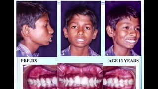 HIGH PULL HEADGEAR.pptx