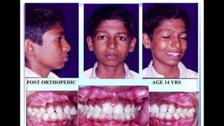 HIGH PULL HEADGEAR.pptx