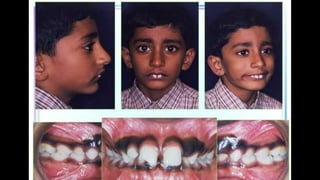 HIGH PULL HEADGEAR.pptx