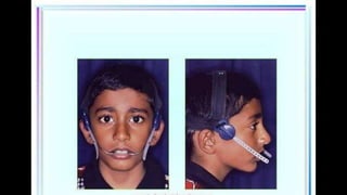 HIGH PULL HEADGEAR.pptx