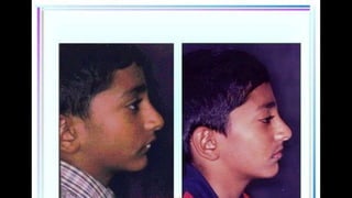 HIGH PULL HEADGEAR.pptx