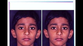 HIGH PULL HEADGEAR.pptx