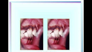 HIGH PULL HEADGEAR.pptx