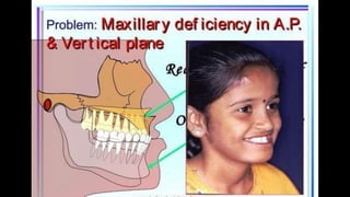 HIGH PULL HEADGEAR.pptx
