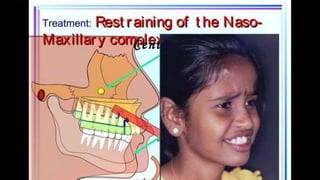 HIGH PULL HEADGEAR.pptx