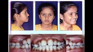 HIGH PULL HEADGEAR.pptx