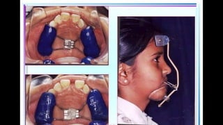 HIGH PULL HEADGEAR.pptx