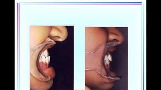 HIGH PULL HEADGEAR.pptx