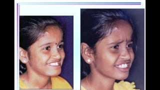 HIGH PULL HEADGEAR.pptx