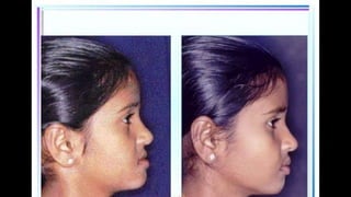 HIGH PULL HEADGEAR.pptx