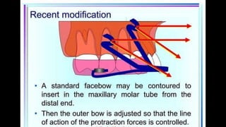 HIGH PULL HEADGEAR.pptx