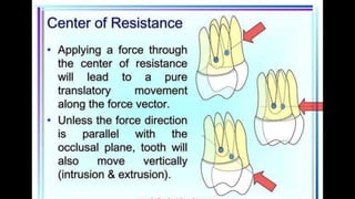 HIGH PULL HEADGEAR.pptx