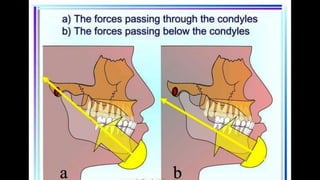 HIGH PULL HEADGEAR.pptx