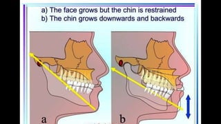 HIGH PULL HEADGEAR.pptx