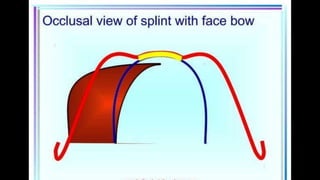 HIGH PULL HEADGEAR.pptx