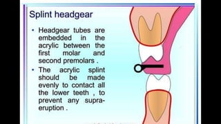 HIGH PULL HEADGEAR.pptx