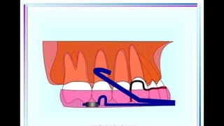 HIGH PULL HEADGEAR.pptx