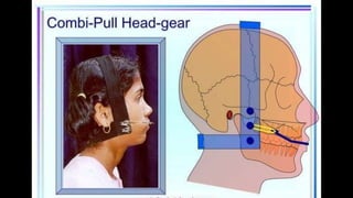 HIGH PULL HEADGEAR.pptx