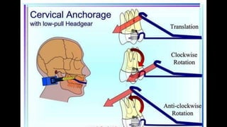 HIGH PULL HEADGEAR.pptx