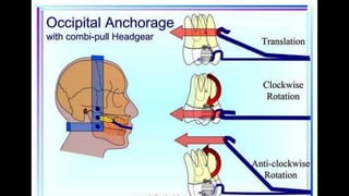 HIGH PULL HEADGEAR.pptx