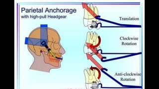 HIGH PULL HEADGEAR.pptx