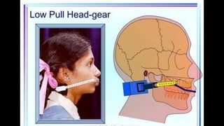 HIGH PULL HEADGEAR.pptx