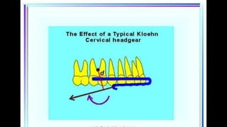 HIGH PULL HEADGEAR.pptx