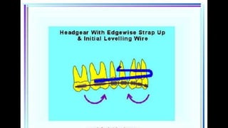 HIGH PULL HEADGEAR.pptx