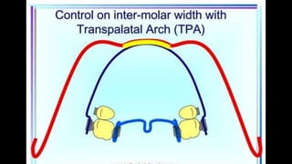 HIGH PULL HEADGEAR.pptx
