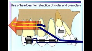 HIGH PULL HEADGEAR.pptx