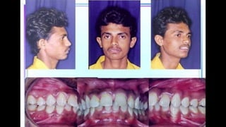 HIGH PULL HEADGEAR.pptx