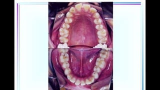 HIGH PULL HEADGEAR.pptx