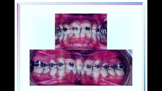 HIGH PULL HEADGEAR.pptx