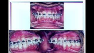 HIGH PULL HEADGEAR.pptx