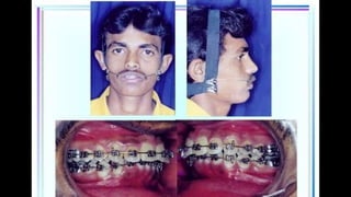 HIGH PULL HEADGEAR.pptx