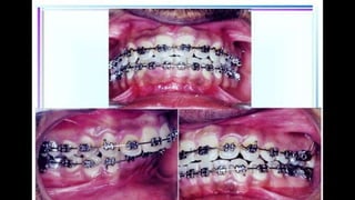 HIGH PULL HEADGEAR.pptx