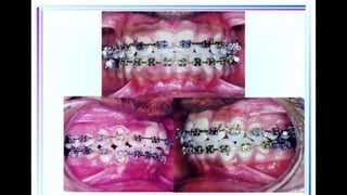 HIGH PULL HEADGEAR.pptx