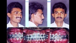 HIGH PULL HEADGEAR.pptx