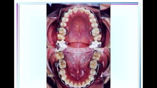 HIGH PULL HEADGEAR.pptx