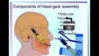 HIGH PULL HEADGEAR.pptx