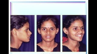 HIGH PULL HEADGEAR.pptx