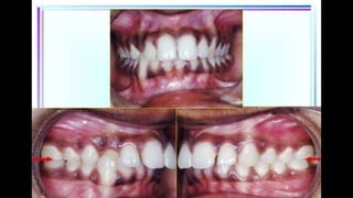 HIGH PULL HEADGEAR.pptx