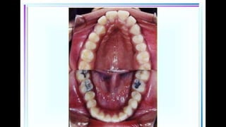 HIGH PULL HEADGEAR.pptx