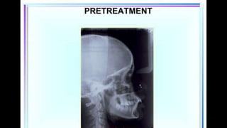 HIGH PULL HEADGEAR.pptx