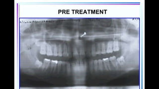 HIGH PULL HEADGEAR.pptx