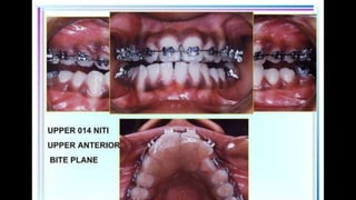 HIGH PULL HEADGEAR.pptx