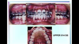 HIGH PULL HEADGEAR.pptx