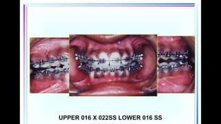 HIGH PULL HEADGEAR.pptx